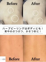 毛穴ラボ 新宿(毛穴LABO)&nbsp;背中 ニキビケア