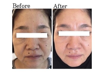 ハイケア グラン ギンザ(HYCARE GRAND GINZA)/日本ーの肌改善サロン実力/銀座