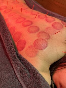 アルバ暁子鍼灸治療院(alba暁子鍼灸治療院)/インディバと鍼灸と吸い玉