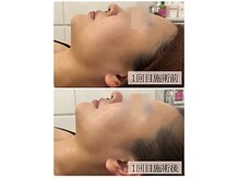 リノン(LINON)/ハーブピーリング 施術回数１回