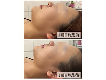 リノン(LINON)/ハーブピーリング 施術回数1回