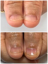 リーフ(Leaf)/噛み爪の方の3週間後