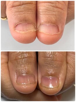 リーフ(Leaf)/噛み爪の方の3週間後