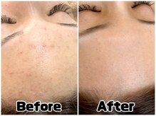 アンドエミニー エン ラボーテ(& EMINY 艶 la beaute)の雰囲気（当店でのケアを続けた結果！ニキビ肌が綺麗になりました！）
