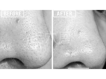 ビビ(VIVI)/毛穴ケアにララピーリング