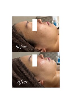 エクラ(ECLAT)/マーメイドセルトリートメント