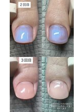 ネイルサロン チェリッシュ(Nailsalon Cherish)/HeySwitch巻き爪ジェル 表面変化