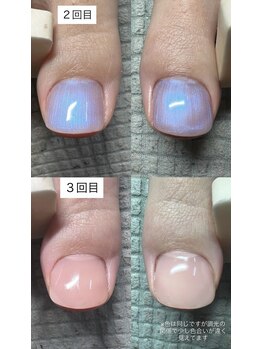 ネイルサロン チェリッシュ(Nailsalon Cherish)/HeySwitch巻き爪ジェル 表面変化
