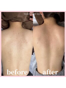 スピカ(Spica)/背中REVI剥けるハーブピーリング