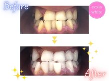 エクシアホワイトニング 六本木店/ホワイトニングビフォーアフター