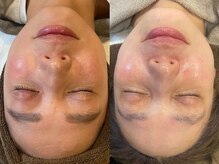 トトノエ(TOTONOE)/美肌育成フェイシャル