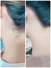アップヘアーがさらに綺麗☆うなじ(襟足)シェービング+光脱毛　4000円