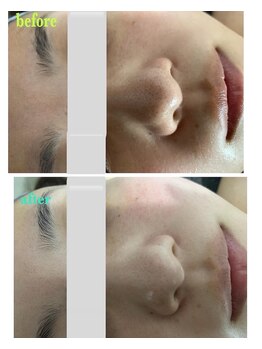 シャルム(Charme)/ご新規様ピーリングフェイシャル