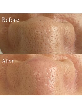 ベルカーラ(Belcarra)/毛穴洗浄ハイドロピーリング