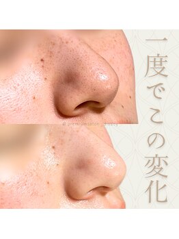 ディバティ(DIVATY)/毛穴/ニキビケア/肌荒れに効果◎