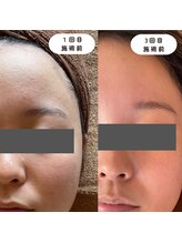 ウーマンビーヘルス(woman Be Health)/ハーブピーリング3回