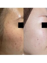 ネオオアシス トウキョウ(ネオOASIS TOKYO)/ハーブピーリング（剥離あり）