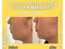 イーラボ 池袋店(e-LABO)/レモンボトル+ラジオ波Lift
