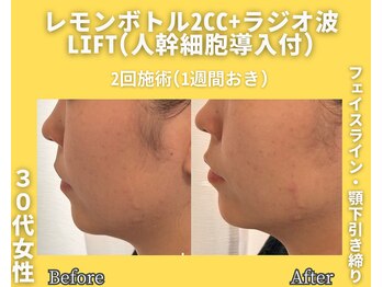 イーラボ 池袋店(e-LABO)/レモンボトル+ラジオ波Lift