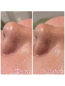 ビオラ(美ola)/新ピーリング！ダクトピール