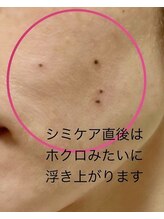 ボディメイキング キキ(Bodymaking KIKI)/シミケア