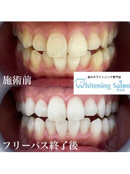ホワイトニングサロン 熊本店/通い放題のホワイトニング