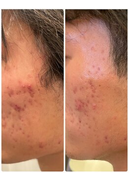 長寿鍼灸院 長寿整骨院/美容鍼25本の効果★ニキビ改善