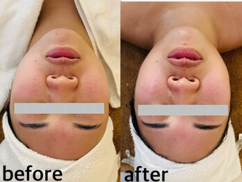 メナードフェイシャルサロン 西五反田/小顔/毛穴/赤み