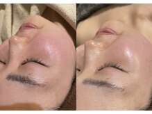 ティースタイル(T-Style)/before/after