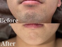 ボス 岡崎店(BOSS)/【メンズ脱毛/ヒゲ脱毛】