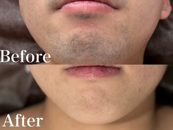 ボス 岡崎店(BOSS)/【メンズ脱毛/ヒゲ脱毛】