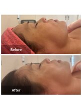 サロンドデュイ/1回施術/50代/たるみケア/シミ