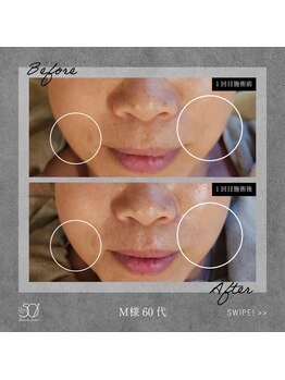 ゴーマルイチ(501)/光フェイシャル Before/After