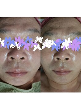 おうちサロン しゅろ/ハーブピーリング　B/A