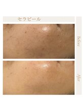 icca～大人の上質サロン～《韓国式セラピール/脱毛/毛穴洗浄/ネイル》大宰府店/セラピール