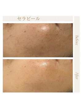 icca～大人の上質サロン～《韓国式セラピール/脱毛/毛穴洗浄/ネイル》大宰府店/セラピール