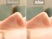 ボーンオム(Born Homme)/毛穴洗浄＋美容液導入：20代女性