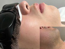 ブレイヴ(BRAVE)/【ひげ脱毛】頬→6回目