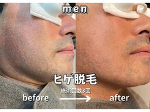 キュー(cue)/【メンズ】「ヒゲ脱毛」3回