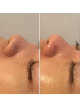 ラヴィ(La vie)/毛穴エクストラクション/黒ずみ