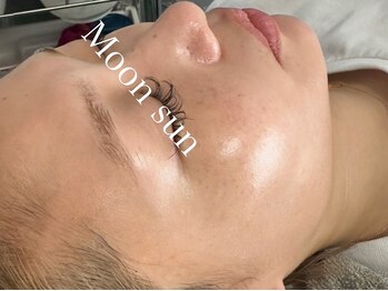 ムーンサン(Moon sun)/陶肌トリートメント