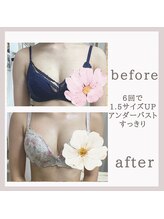 アリサナ(Arisana)/症例写真　バスト　葛西