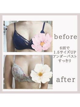 アリサナ(Arisana)/症例写真　バスト　葛西