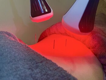 オプト鍼灸整体院 たまプラーザ本院(opt.鍼灸整体院)/スーパーライザー