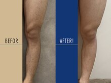 ロペス(Lopez)/【あし脱毛】3回施術例