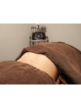 鍼灸施術を受けたい