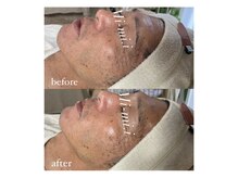 ミーミドットアイ(Mi-mi.i)/艶肌フェイシャルワックス脱毛