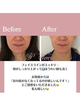 ピオニー(Peony)/Before & After