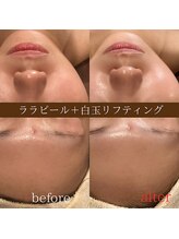 ディースズ(D.suzu)/ララピール×白玉（リフトUP）