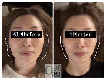 キュープ 福岡天神店(Qpu)/通常コース4回での変化